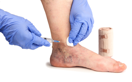 2️⃣ 혈관경화요법 (Sclerotherapy)