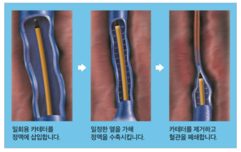 3️⃣ 고주파 정맥류 열폐쇄술 (RFA)