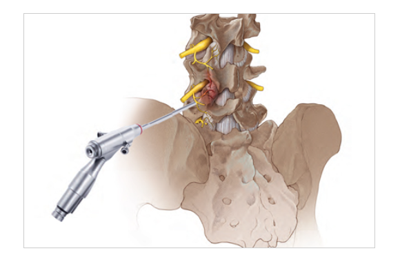 3 단일공 고주파 치료