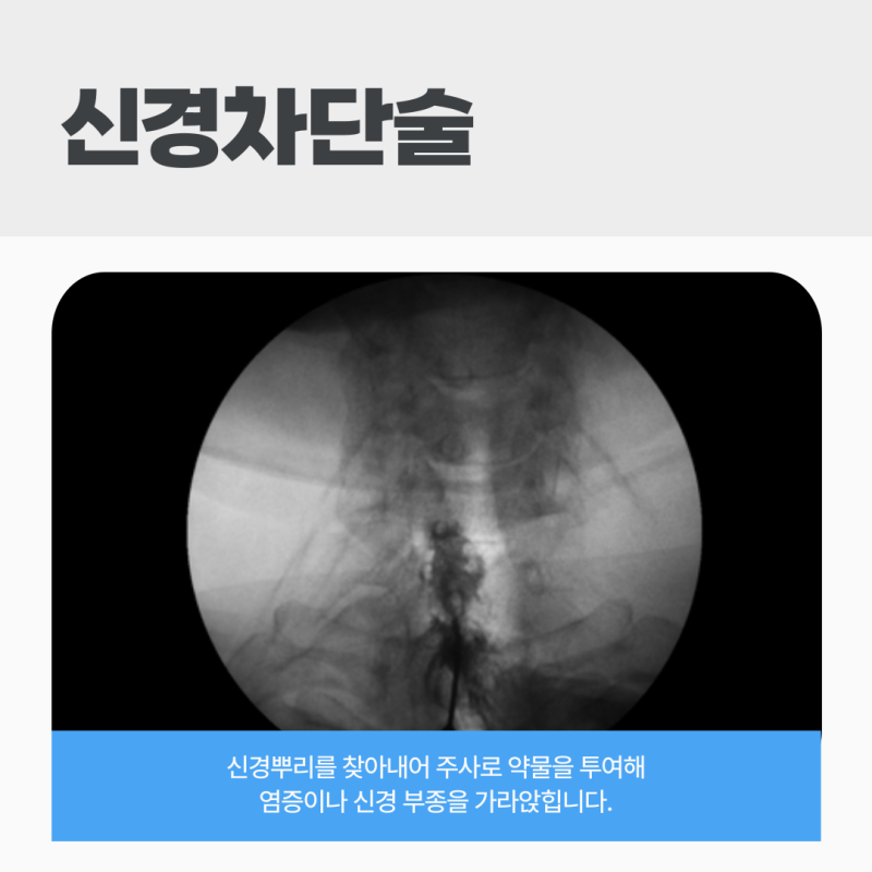 4 신경성형술(PEN)