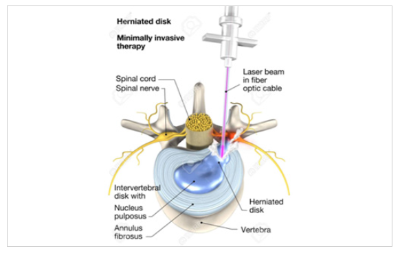 대표적인 비수술 치료 방법
