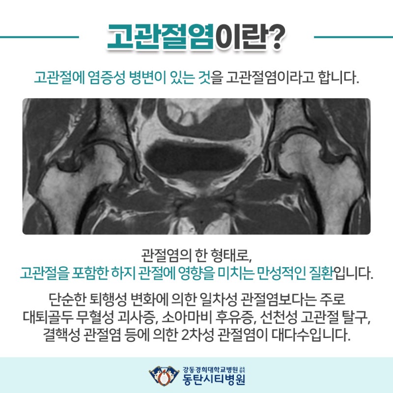 체중 지지 중심인 고관절의 역할과 중요성