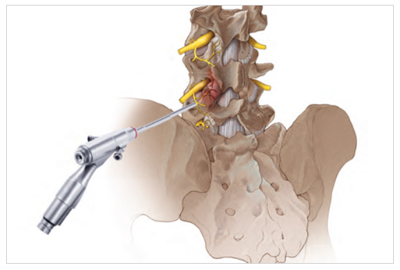 4단계  디스크 격리 – 수술적 치료 검토 시점