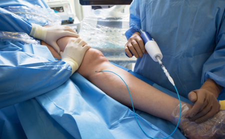 4️⃣ 베나실(Venaseal) 접착 폐쇄술