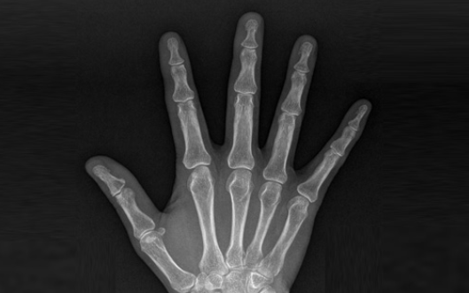 트리거 핑거 발생 원인과 위험 직업군