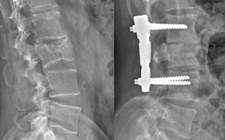 Curl Up 복부 코어 강화 운동