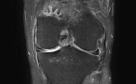 무릎연골판손상 오산 정형외과 치료방법과 빠른 회복 비결 6 초기 관리 및 비수술 치료법