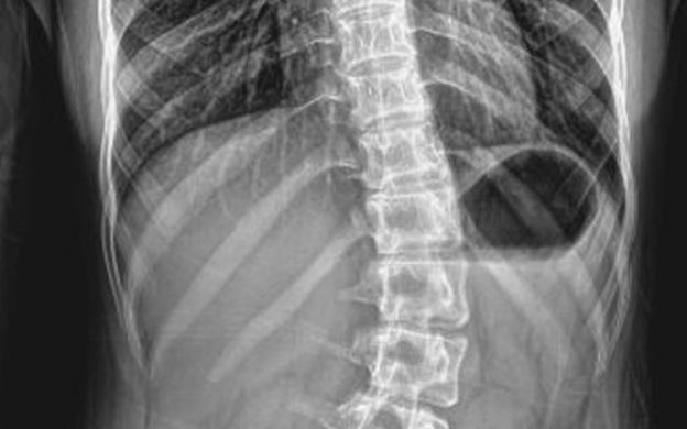 척추측만증의 주요 증상과 일상 속 변화