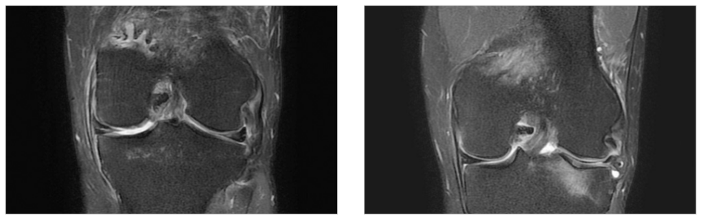 오산무릎관절경수술