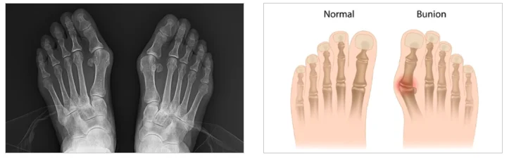 2동탄정형외과|무지외반증 X-ray 및 정상 발과 비교 설명 이미지