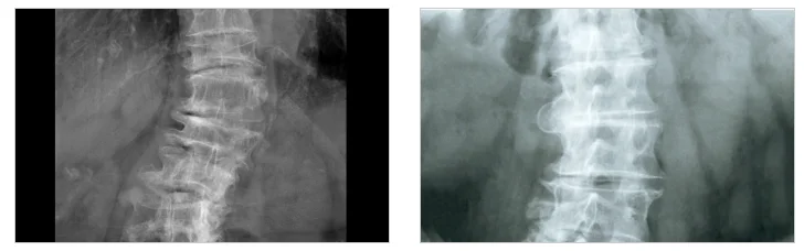 좌골신경통 비수술|허리 척추 X-ray 의료 이미지