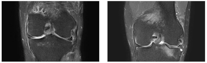 동탄정형외과입원|무릎 관절 MRI 영상