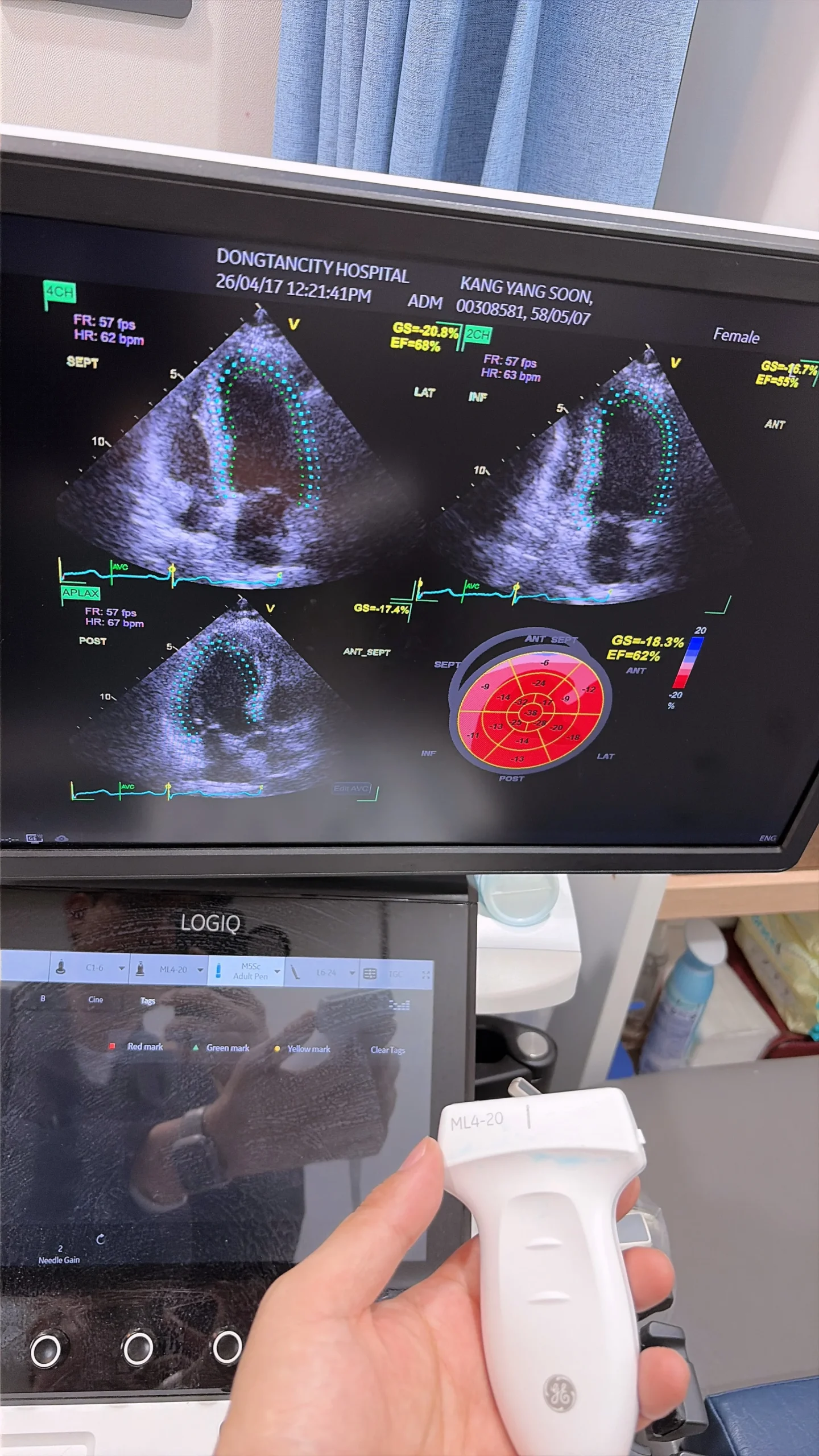 동탄정형외과입원|심장초음파 검사 결과 화면과 초음파 장비