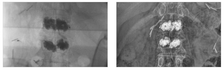 동탄 병점 정형외과 추천|척추 골시멘트 시술 전후 X-ray 의료 영상