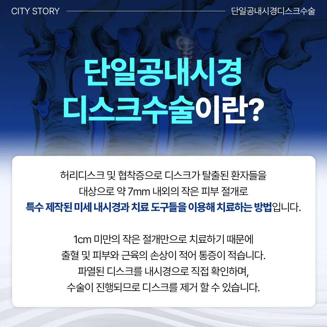 동탄 허리디스크 비수술치료|단일공내시경 디스크수술의 정의와 장점 설명 카드뉴스