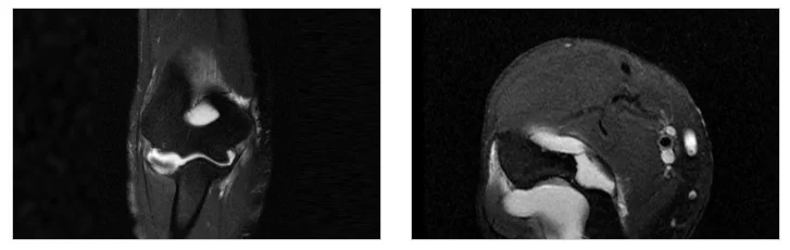 화성 골프엘보 초기 증상|팔꿈치 관절의 MRI 영상