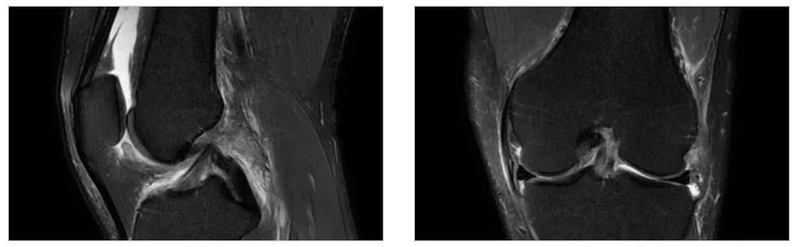 병점 통풍성관절염 초기 증상|무릎 관절의 MRI 검사 이미지