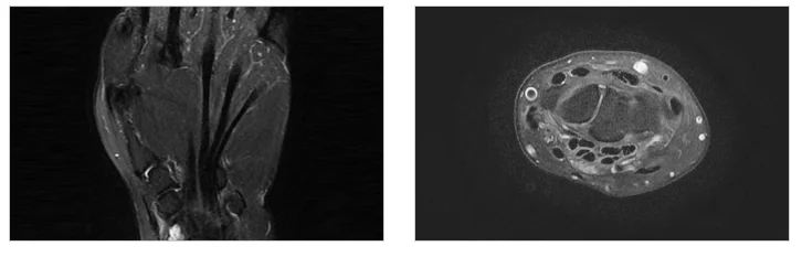 동탄 발목 인대 파열 회복 기간|발과 발목 부위의 MRI 영상