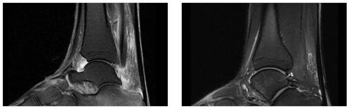 오산 성인 척추 측만증 운동|발목 관절의 MRI 영상