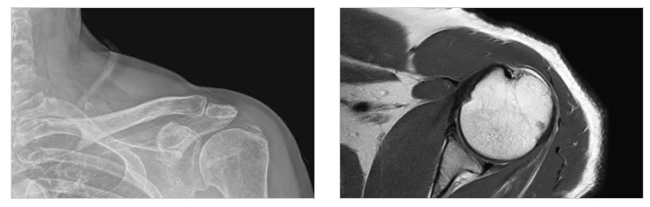 동탄 AI 영상진단센터 정확도|어깨 X-ray 및 MRI 의료영상