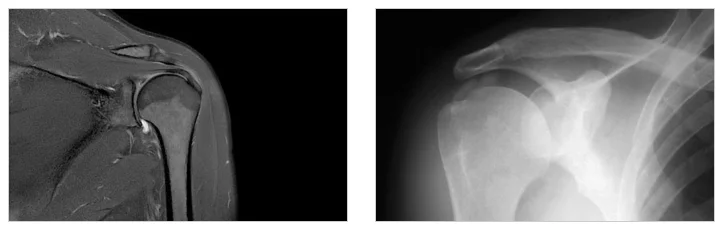 동탄 어깨 석회화건염 진단|어깨 MRI 및 X-ray 의료 영상