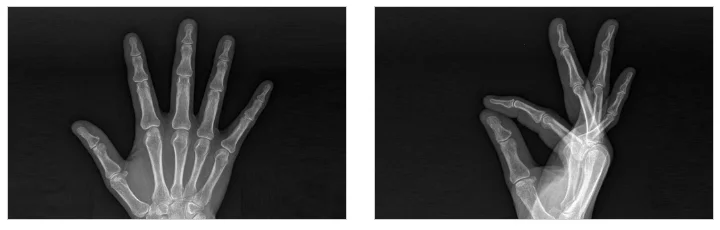 오산 손목터널증후군 수술 시기|손의 뼈를 보여주는 X-ray 이미지