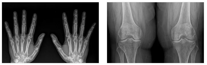 병점 십자인대 재건술 후기|손과 무릎의 X-ray 사진
