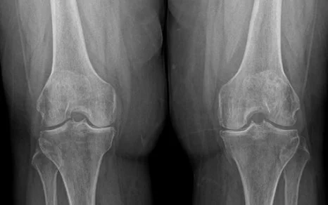 화성 척추 수술 정밀 진단|양쪽 무릎 X-ray 의료 영상