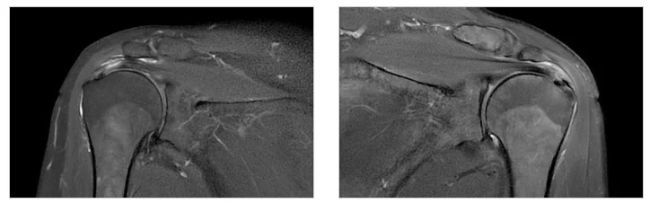 동탄 회전근개파열 검사, 정확한 진단이 첫 단추인 이유 1 회전근개파열 검사|어깨 MRI 의료 영상